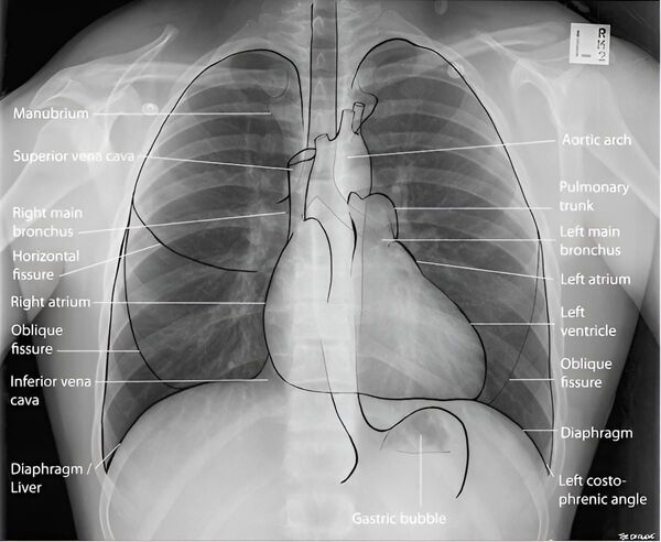رادیوگرافی از قفسه سینه (CXR)